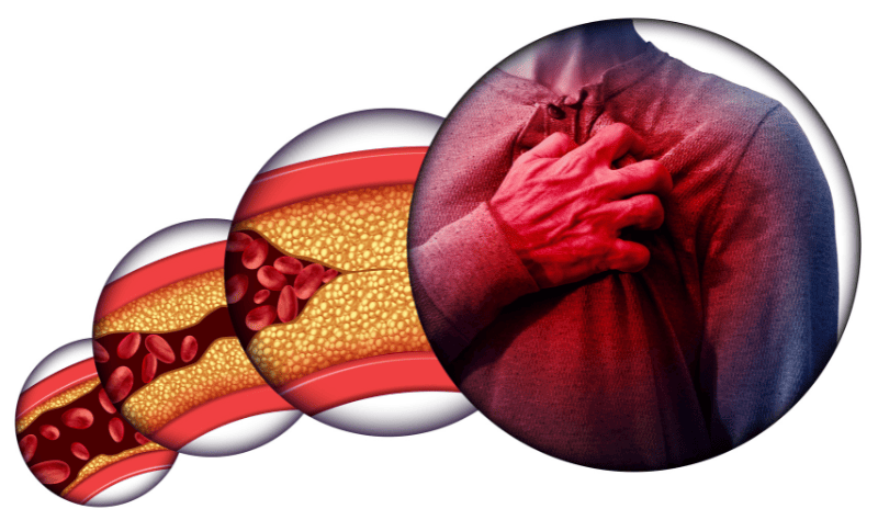 Ilustrasi penyumbatan jantung